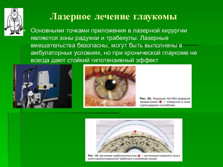 Лазерное лечение глаукомы Основными точками приложения в лазерной хирургии являются зоны радужки и