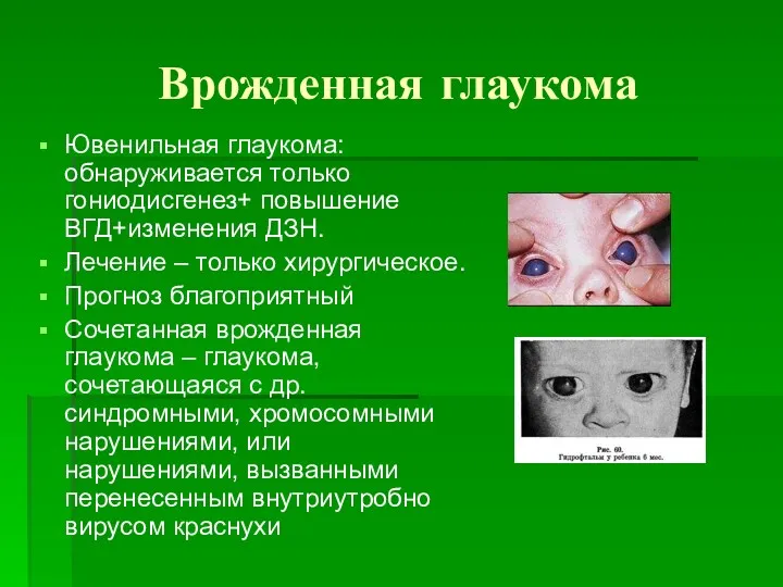 Врожденная глаукома Ювенильная глаукома: обнаруживается только гониодисгенез+ повышение ВГД+изменения ДЗН. Лечение – только