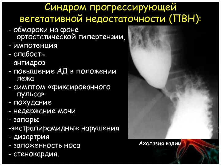 Синдром прогрессирующей вегетативной недостаточности (ПВН): - обмороки на фоне ортостатической