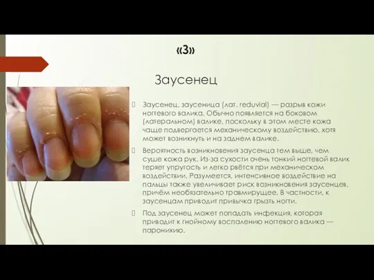 «З» Заусенец Заусенец, заусеница (лат. reduvial) — разрыв кожи ногтевого валика. Обычно появляется