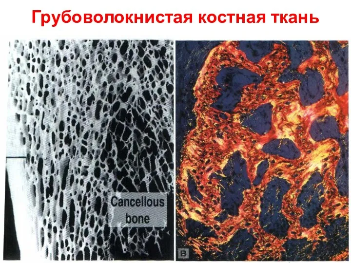 Грубоволокнистая костная ткань