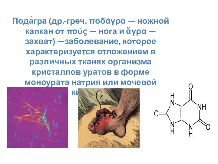 Пода́гра (др.-греч. ποδάγρα — ножной капкан от πούς — нога