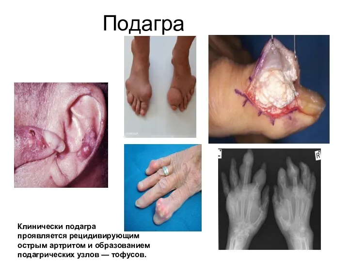 Подагра Клинически подагра проявляется рецидивирующим острым артритом и образованием подагрических узлов — тофусов.