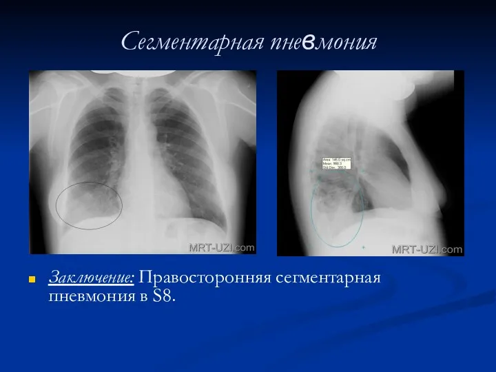 Сегментарная пневмония Заключение: Правосторонняя сегментарная пневмония в S8.