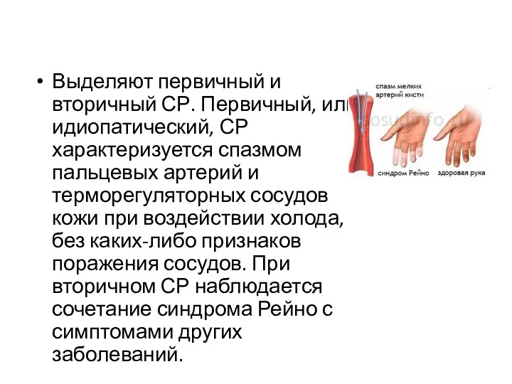 Выделяют первичный и вторичный СР. Первичный, или идиопатический, СР характеризуется