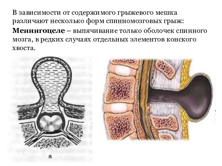 В зависимости от содержимого грыжевого мешка различают несколько форм спинномозговых грыж: Менингоцеле –
