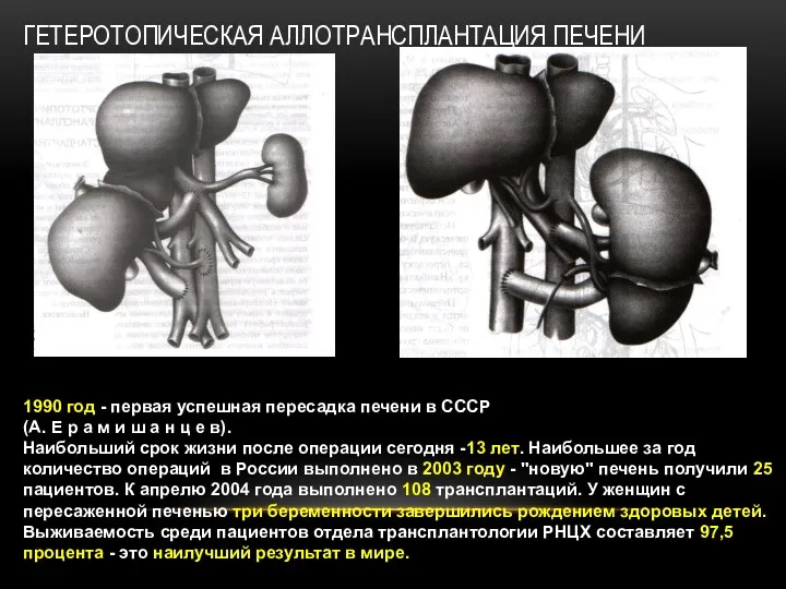 ГЕТЕРОТОПИЧЕСКАЯ АЛЛОТРАНСПЛАНТАЦИЯ ПЕЧЕНИ 1990 год - первая успешная пересадка печени