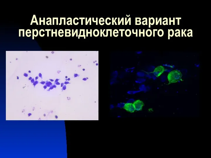 Анапластический вариант перстневидноклеточного рака