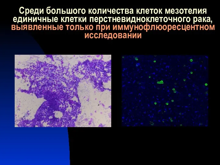 Среди большого количества клеток мезотелия единичные клетки перстневидноклеточного рака, выявленные только при иммунофлюоресцентном исследовании