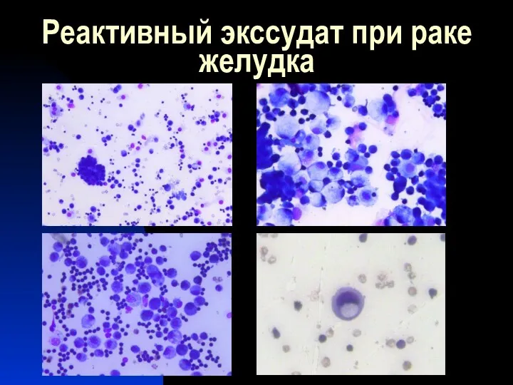 Реактивный экссудат при раке желудка