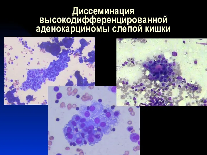 Диссеминация высокодифференцированной аденокарциномы слепой кишки