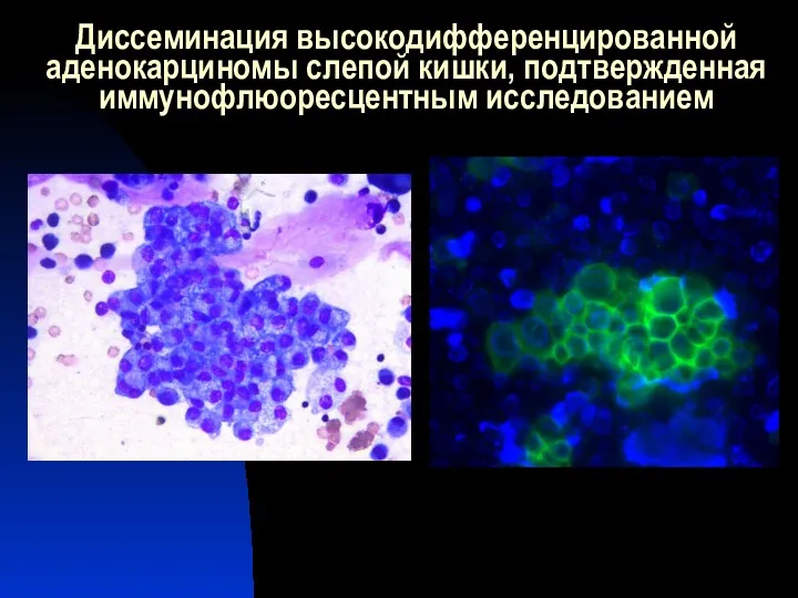 Диссеминация высокодифференцированной аденокарциномы слепой кишки, подтвержденная иммунофлюоресцентным исследованием