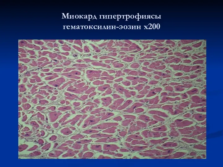 Миокард гипертрофиясы гематоксилин-эозин х200