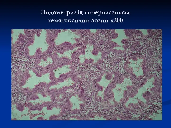 Эндометридің гиперплазиясы гематоксилин-эозин х200