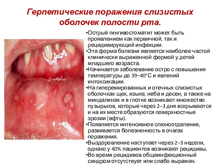 Герпетические поражения слизистых оболочек полости рта. Острый гингивостоматит может быть