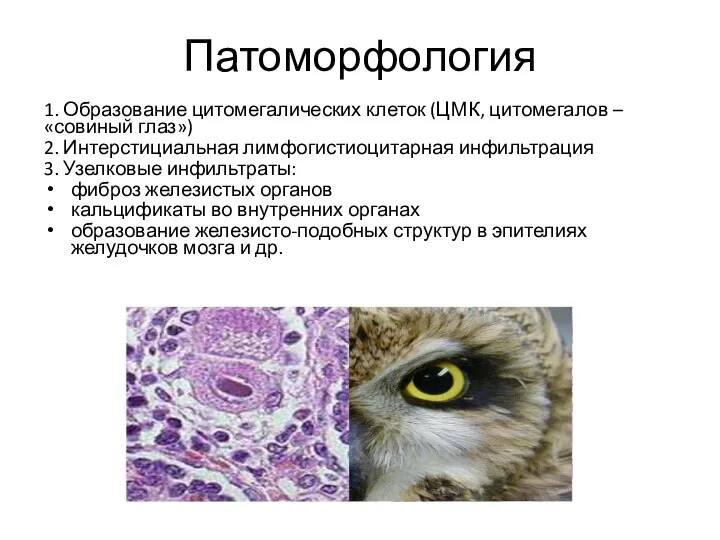 Патоморфология 1. Образование цитомегалических клеток (ЦМК, цитомегалов – «совиный глаз»)