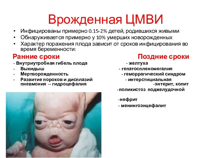 Врожденная ЦМВИ Инфицированы примерно 0.15-2% детей, родившихся живыми Обнаруживается примерно