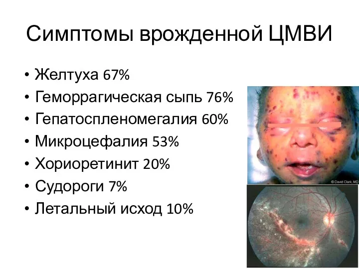 Симптомы врожденной ЦМВИ Желтуха 67% Геморрагическая сыпь 76% Гепатоспленомегалия 60%