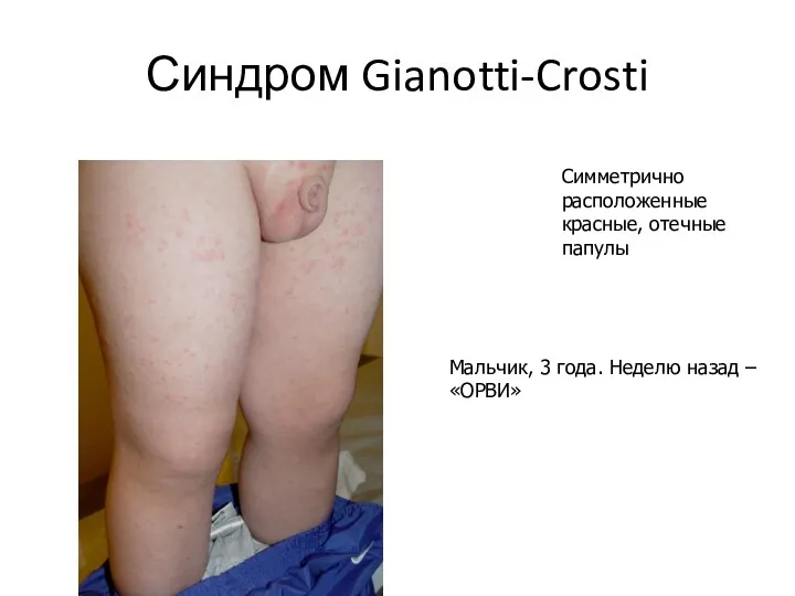 Синдром Gianotti-Crosti Мальчик, 3 года. Неделю назад – «ОРВИ» Симметрично расположенные красные, отечные папулы