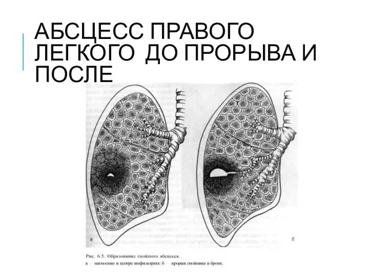 АБСЦЕСС ПРАВОГО ЛЕГКОГО ДО ПРОРЫВА И ПОСЛЕ