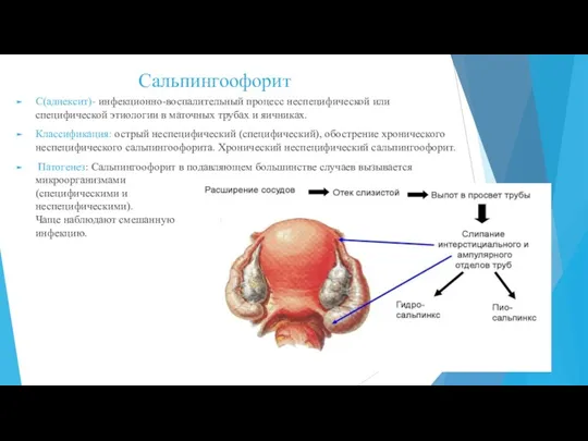 Сальпингоофорит С(аднексит)- инфекционно-воспалительный процесс неспецифической или специфической этиологии в маточных