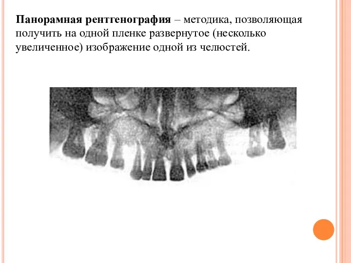 Панорамная рентгенография – методика, позволяющая получить на одной пленке развернутое (несколько увеличенное) изображение одной из челюстей.