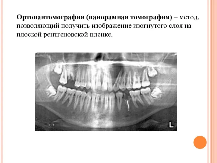 Ортопантомография (панорамная томография) – метод, позволяющий получить изображение изогнутого слоя на плоской рентгеновской пленке.