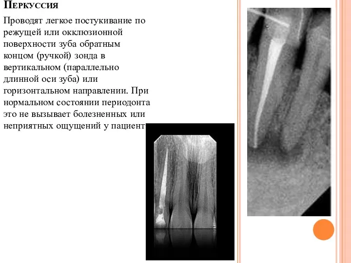 Перкуссия Проводят легкое постукивание по режущей или окклюзионной поверхности зуба