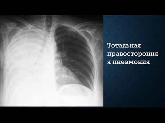 Тотальная правосторонняя пневмония