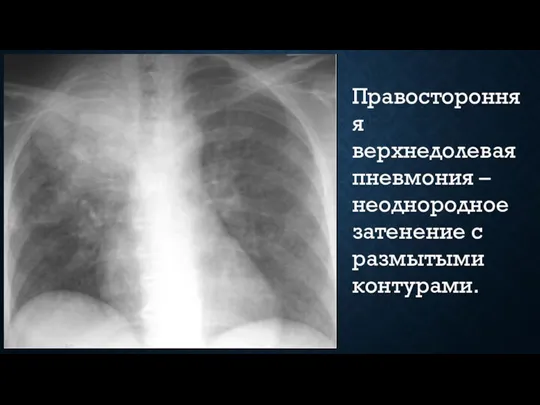 Правосторонняя верхнедолевая пневмония – неоднородное затенение с размытыми контурами.