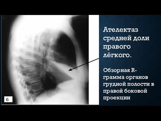 Ателектаз средней доли правого лёгкого. Обзорная R-грамма органов грудной полости в правой боковой проекции