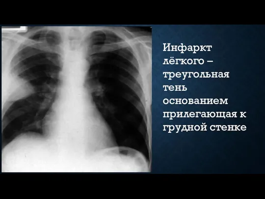 Инфаркт лёгкого – треугольная тень основанием прилегающая к грудной стенке