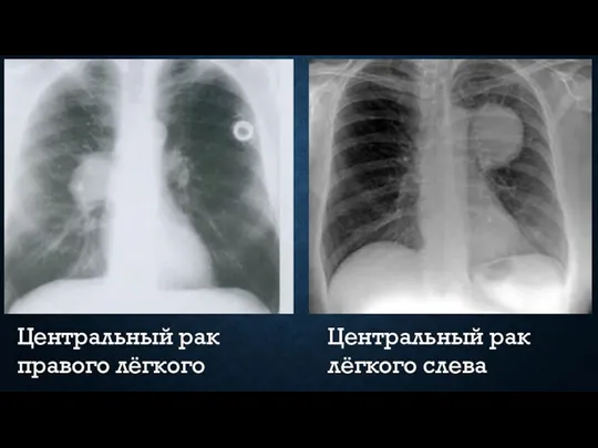 Центральный рак правого лёгкого Центральный рак лёгкого слева