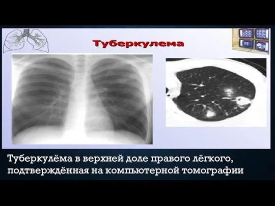 Туберкулёма в верхней доле правого лёгкого, подтверждённая на компьютерной томографии