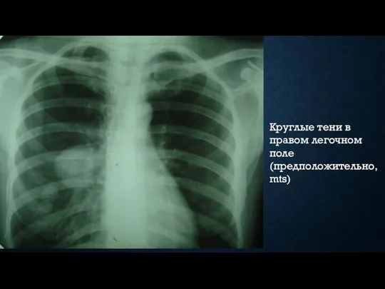 Круглые тени в правом легочном поле (предположительно, mts)