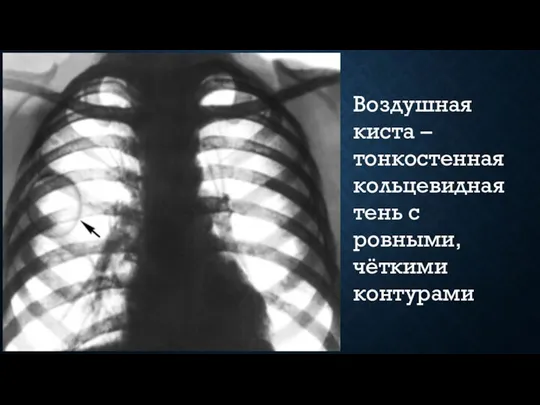 Воздушная киста – тонкостенная кольцевидная тень с ровными, чёткими контурами