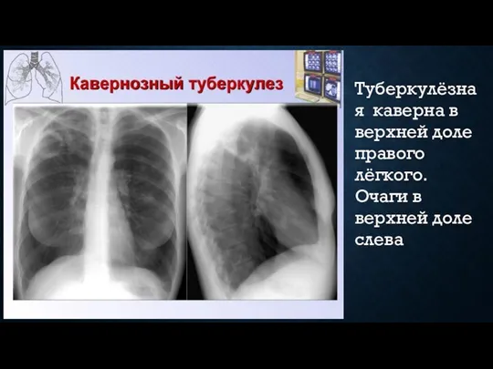 Туберкулёзная каверна в верхней доле правого лёгкого. Очаги в верхней доле слева