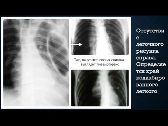 Отсутствие легочного рисунка справа. Определяется край коллабированного легкого