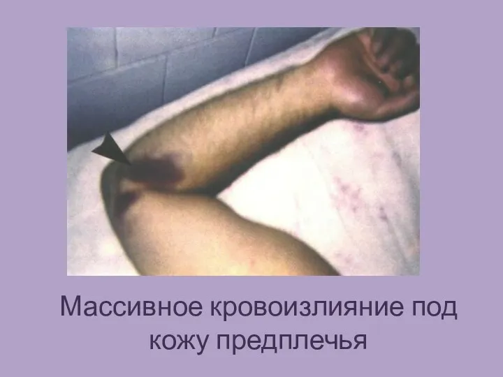 Массивное кровоизлияние под кожу предплечья