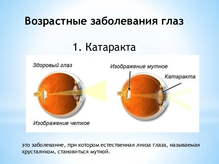 Возрастные заболевания глаз 1. Катаракта это заболевание, при котором естественная линза глаза, называемая хрусталиком, становиться мутной.