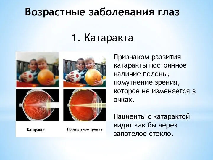 Возрастные заболевания глаз 1. Катаракта Признаком развития катаракты постоянное наличие