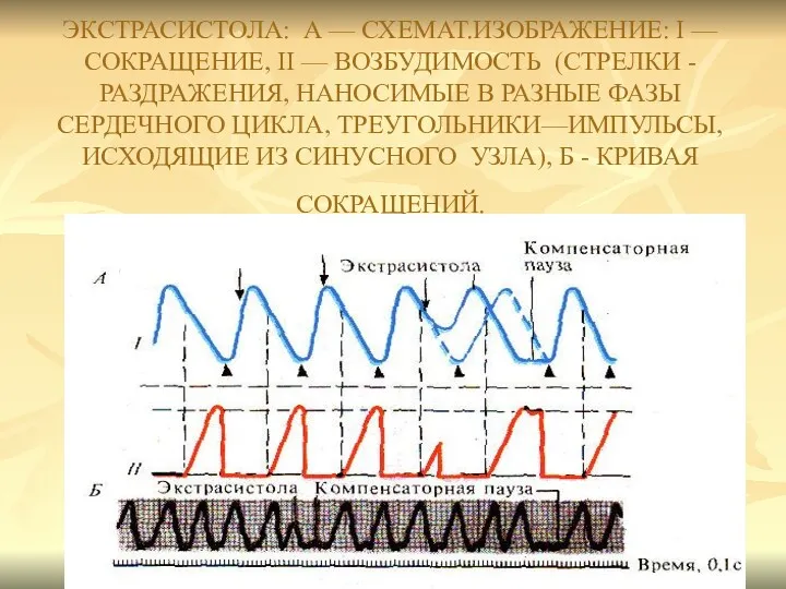 ЭКСТРАСИСТОЛА: А — СХЕМАТ.ИЗОБРАЖЕНИЕ: I — СОКРАЩЕНИЕ, II — ВОЗБУДИМОСТЬ