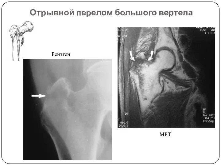 Отрывной перелом большого вертела Рентген МРТ