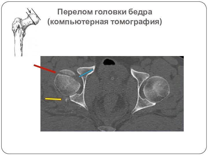 Перелом головки бедра (компьютерная томография)