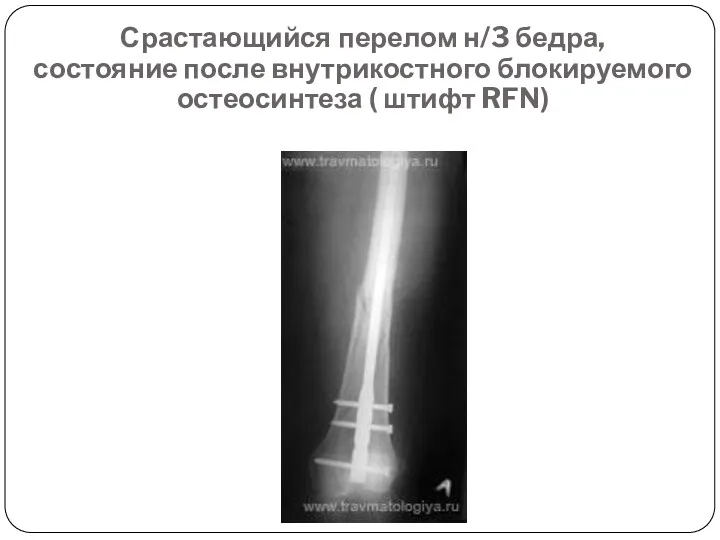 Срастающийся перелом н/3 бедра, состояние после внутрикостного блокируемого остеосинтеза ( штифт RFN)