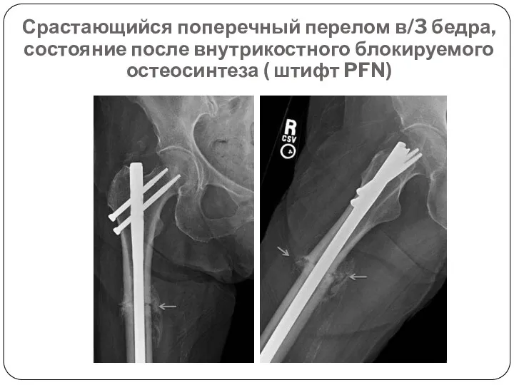 Срастающийся поперечный перелом в/3 бедра, состояние после внутрикостного блокируемого остеосинтеза ( штифт PFN)