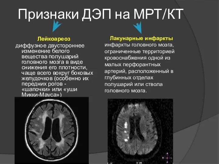 Признаки ДЭП на МРТ/КТ Лейкоареоз диффузное двустороннее изменение белого вещества