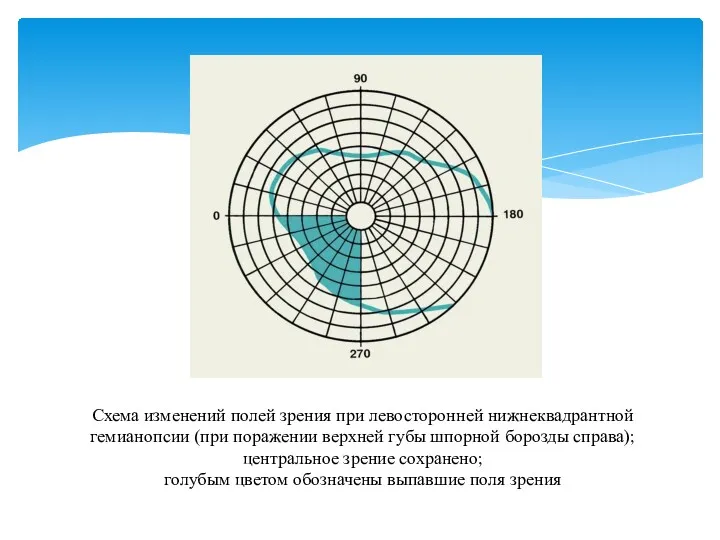 Схема изменений полей зрения при левосторонней нижнеквадрантной гемианопсии (при поражении