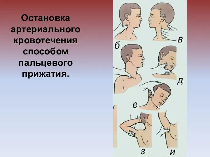 Остановка артериального кровотечения способом пальцевого прижатия.