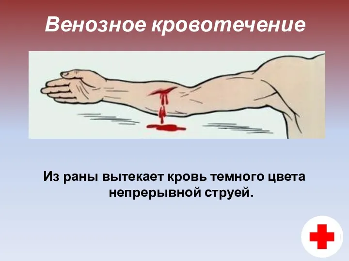 Венозное кровотечение Из раны вытекает кровь темного цвета непрерывной струей.